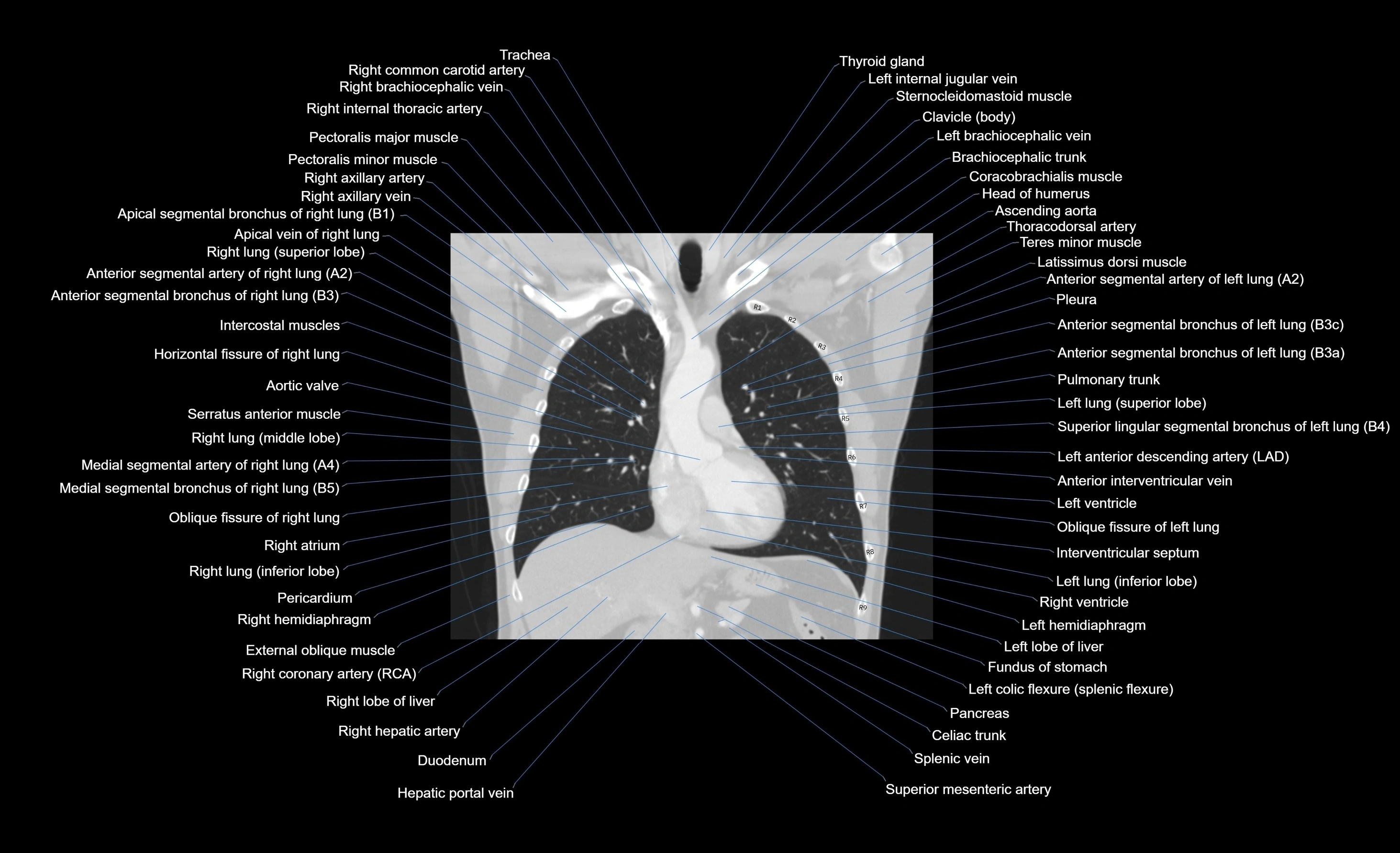 CT chest (thorax) lung window window labelled coronal cross sectional anatomy radiology image-00072.webp